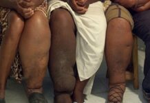 ফাইলেরিয়া বা গোদ রোগের কারন, লক্ষণ ও চিকিৎসা